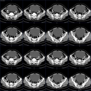 頭部脊索瘤手術(shù)治療后出國質(zhì)子治療