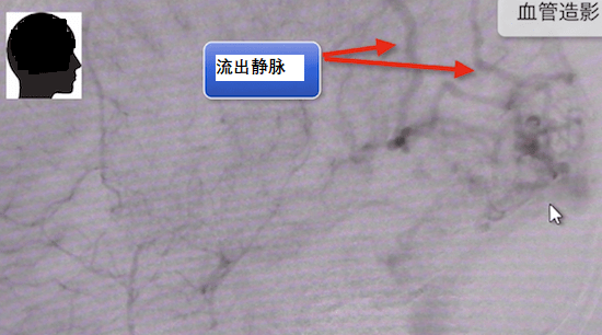 腦動(dòng)靜脈畸形