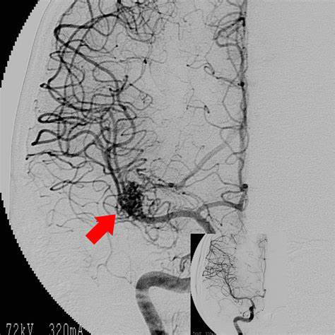 腦動(dòng)靜脈畸形