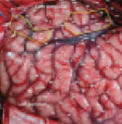 INC專家Rutka教授發(fā)現(xiàn)：MEG評(píng)估兒童頑固性癲癇手術(shù)后的正?；蚍蔷衷钚訫RI表現(xiàn)