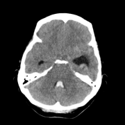 問：妊娠和產(chǎn)褥期會(huì)增加腦動(dòng)靜脈畸形破裂的風(fēng)險(xiǎn)嗎？