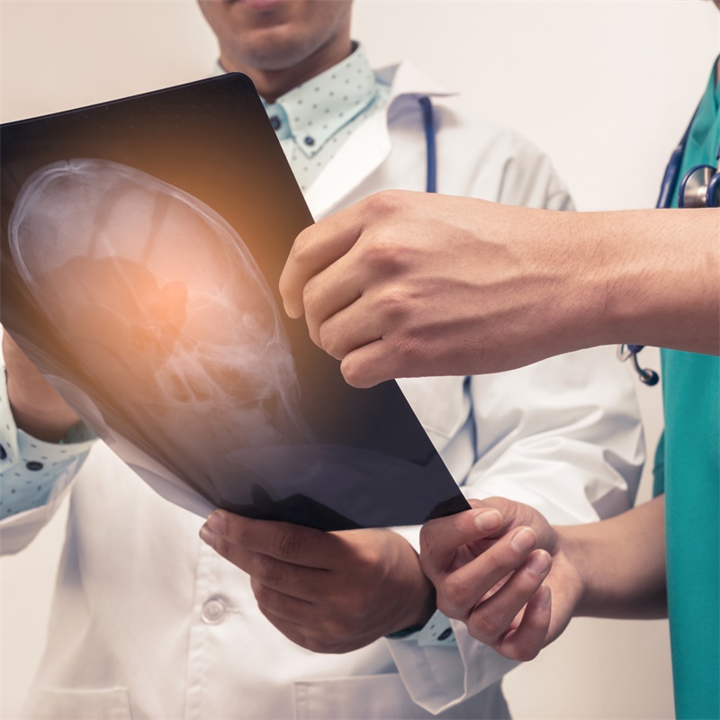 IGFBP2表達(dá)評(píng)估idh突變的膠質(zhì)瘤患者生存