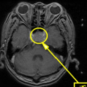 腦垂體瘤癥狀有哪些？如何治療垂體瘤？