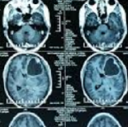 激光間質消融術治療小兒癲癇及腦腫瘤