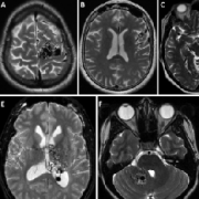 功能區(qū)亞型是否影響動(dòng)靜脈畸形手術(shù)的預(yù)后?