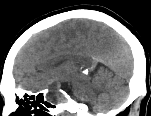 垂體瘤經(jīng)蝶竇手術(shù)常見并發(fā)癥