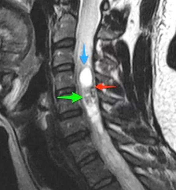 <a href='/bingzhong/smxbl/' target='_blank'><u>髓母細(xì)胞瘤</u></a>