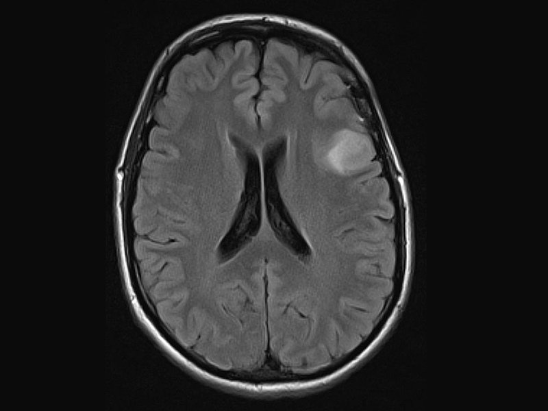 低級別膠質(zhì)瘤的當(dāng)前治療策略
