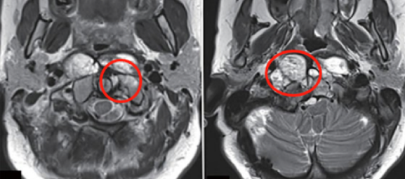 法國脊索瘤手術案例