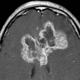 膠質(zhì)瘤3~4級(jí)活多久？MR成像與高級(jí)別膠質(zhì)瘤患者生存率相關(guān)