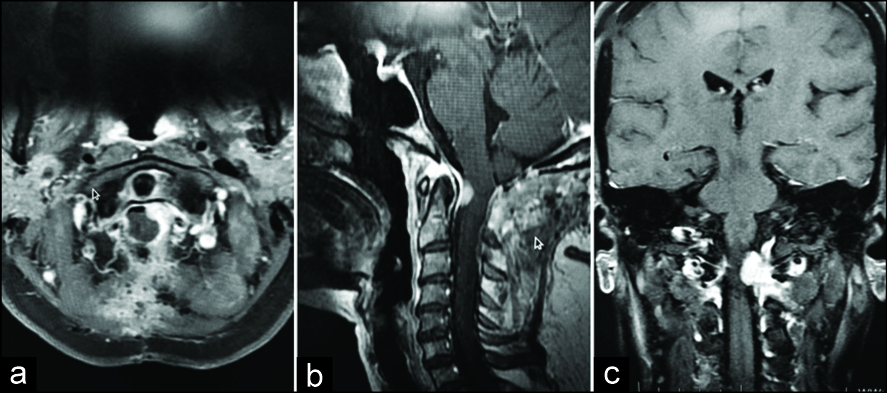 術后對比增強磁共振成像