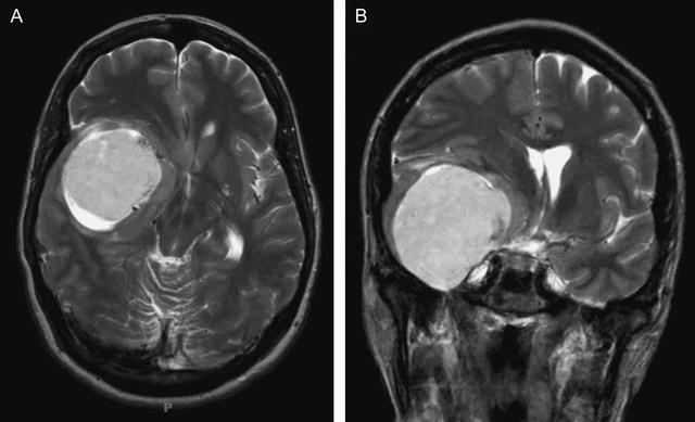 <a href='/bingzhong/naomoliu/' target='_blank'><u>腦膜瘤</u></a>