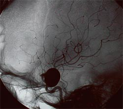 上?？茨X血管瘤有哪家醫(yī)院好？