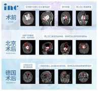 “頭上動(dòng)刀”，這些膠質(zhì)瘤患者選擇出國(guó)手術(shù)的N個(gè)理由