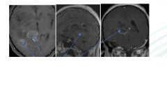 腦瘤到底優(yōu)選手術(shù)、放化療、靶向藥還是臨床試驗(yàn)？