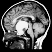 兒童顱咽管瘤壽命?手術(shù)全切有望治愈顱咽管瘤