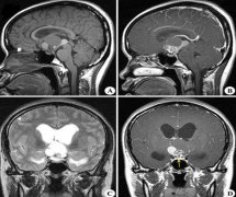 顱咽管瘤遺傳給子女嗎？