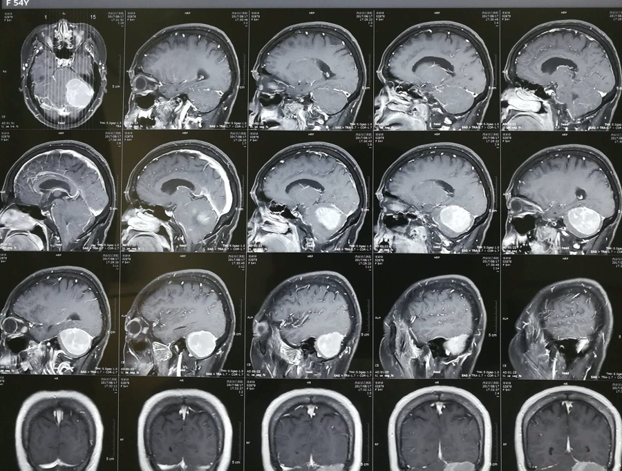 鐮旁腦膜瘤是病嗎？手術難度大嗎？