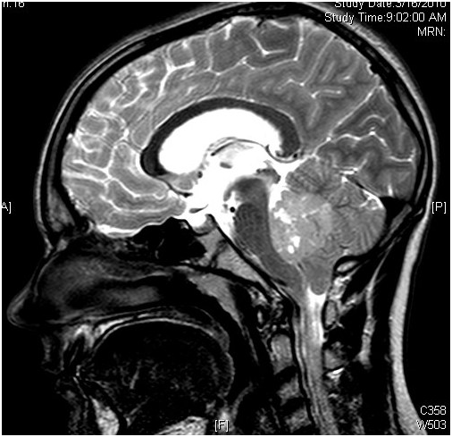 髓母細(xì)胞瘤能活多久？