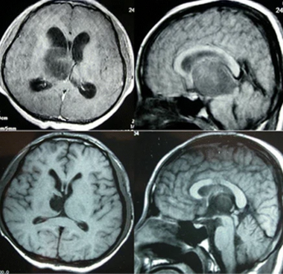 基底節(jié)膠質(zhì)瘤：早期發(fā)現(xiàn)、及時(shí)治療是存活的關(guān)鍵