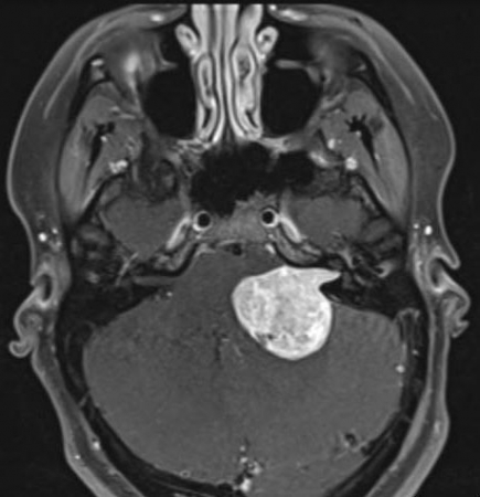 聽(tīng)神經(jīng)瘤能治好嗎？有哪些手術(shù)選擇？