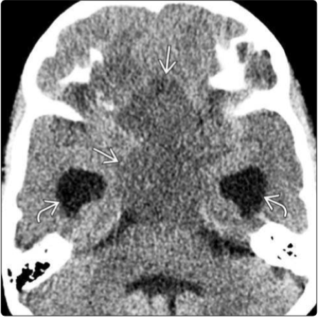 INC腦腫瘤科普|毛細(xì)胞星形細(xì)胞瘤是癌癥嗎？怎么治療？