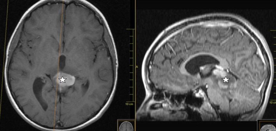 膠質(zhì)瘤案例