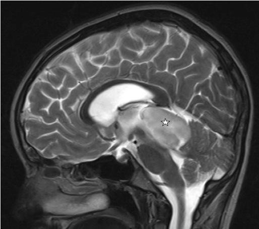 小兒顱內(nèi)原發(fā)性間變性神經(jīng)節(jié)膠質(zhì)瘤治療策略：全切案例一則