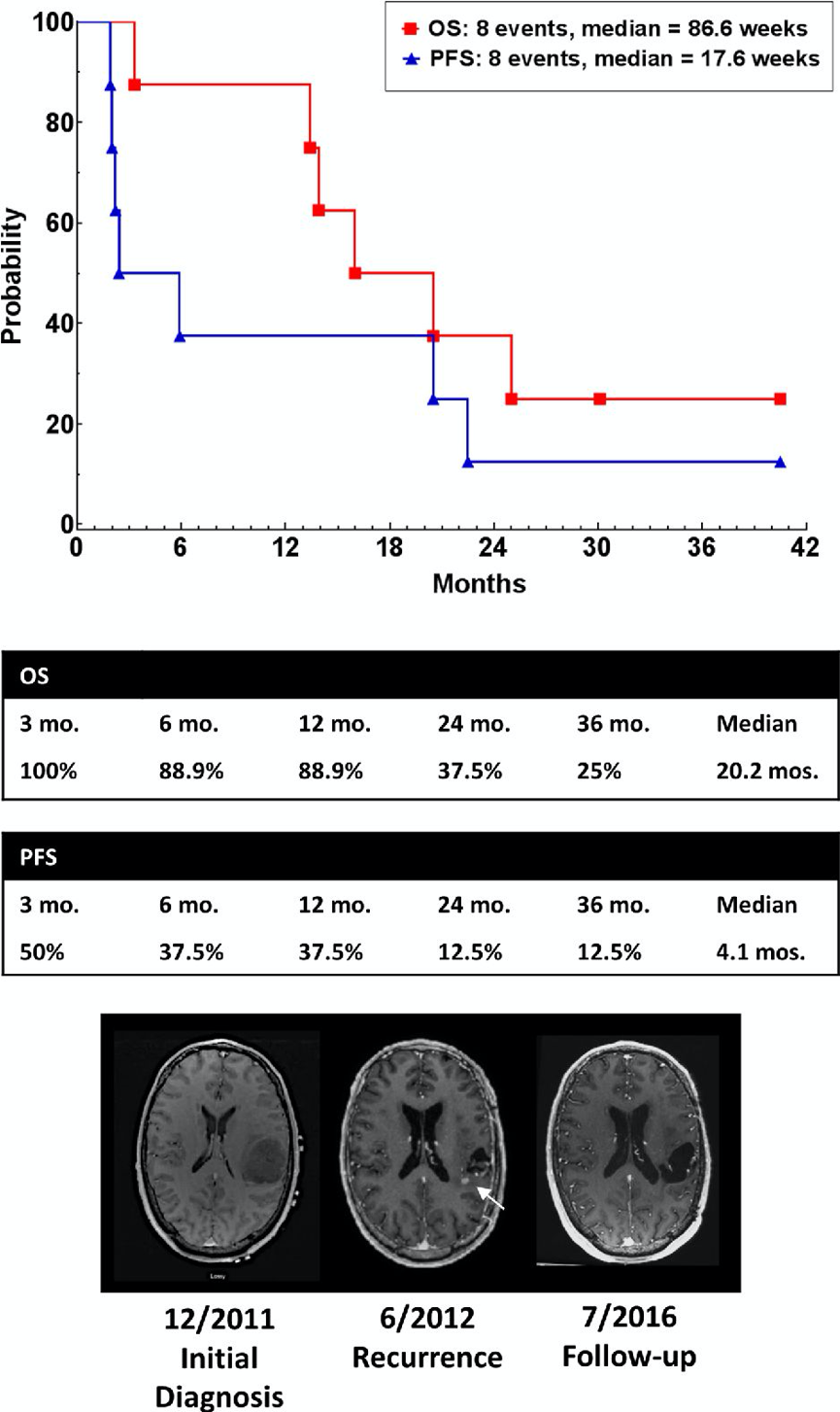 膠質(zhì)母細胞瘤