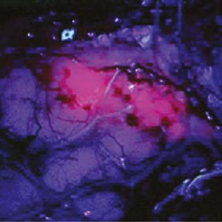 惡性膠質(zhì)瘤