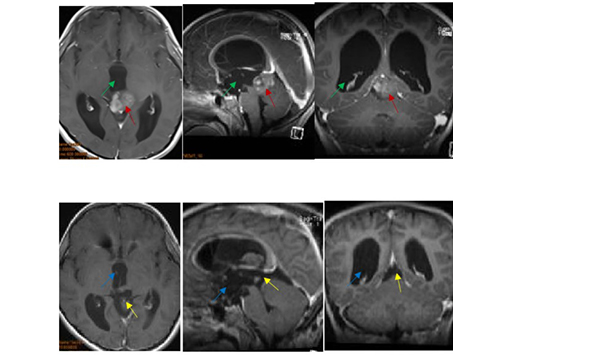 松果體腫瘤案例