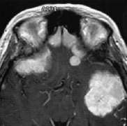 多發(fā)腦膜瘤性腦膜瘤嚴重嗎？如何治療？