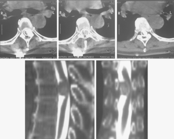 少見的脊髓腦膜瘤癥狀有哪些？如何治療？