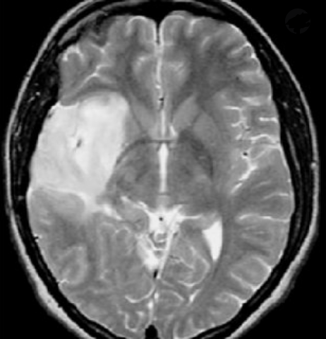 二級少突膠質(zhì)瘤能活30年嗎?