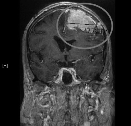 惡性腦膜瘤癥狀有哪些？有什么前沿治療辦法？