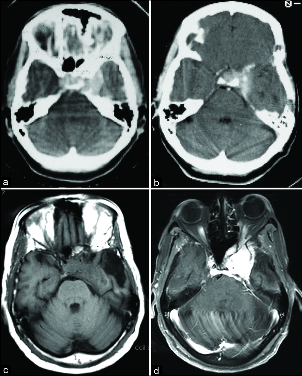 海綿竇腦膜瘤治療好方法