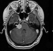 聽神經(jīng)瘤出國(guó)看病綜合治療及案例報(bào)告兩則