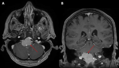 腦膜瘤不做手術(shù)可以嗎？70歲女性斜坡腦膜瘤的延遲治療案例報告