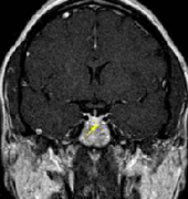 垂體瘤術(shù)后8大并發(fā)癥