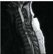 椎管內(nèi)腫瘤（脊髓腫瘤）的分類和臨床癥狀表現(xiàn)