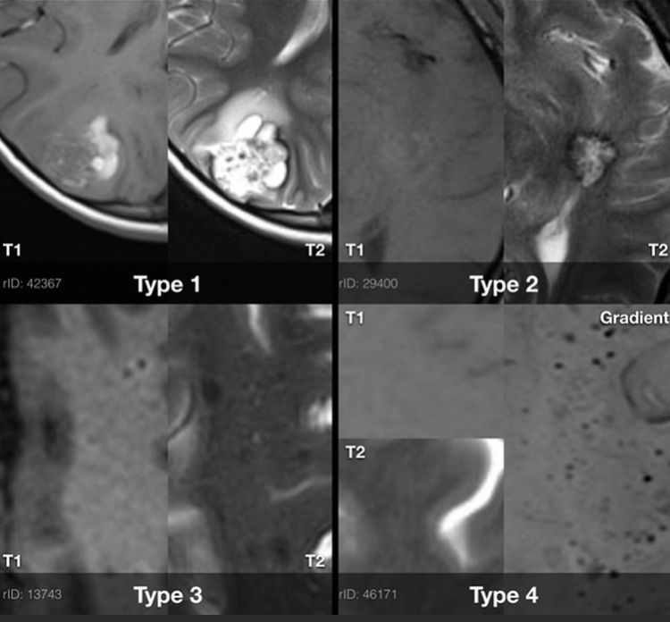 美國巴羅BNI案例：Lawton教授為一對父女成功“清除”腦海綿狀