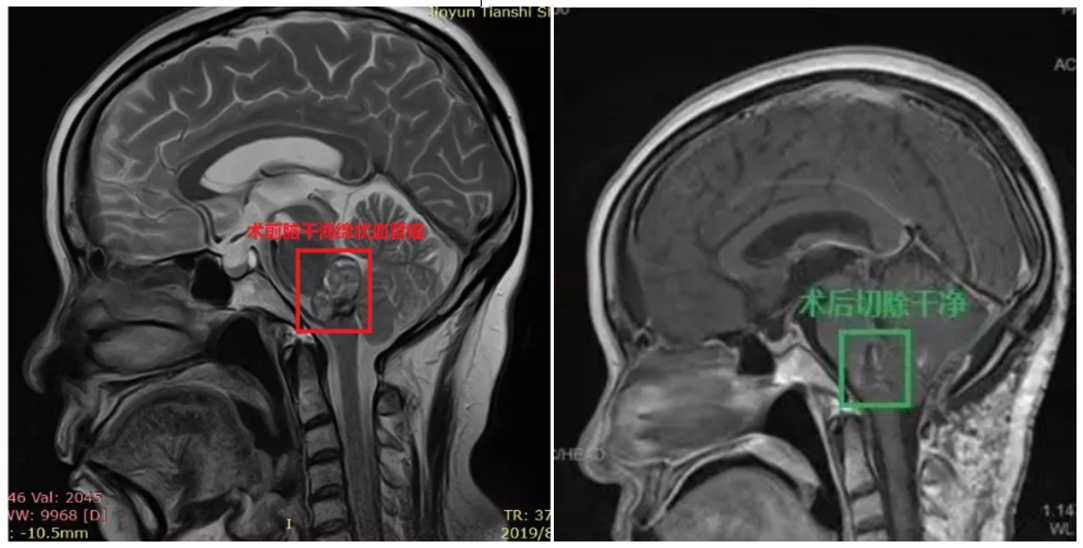 腦干海綿狀血管瘤出血圖片0