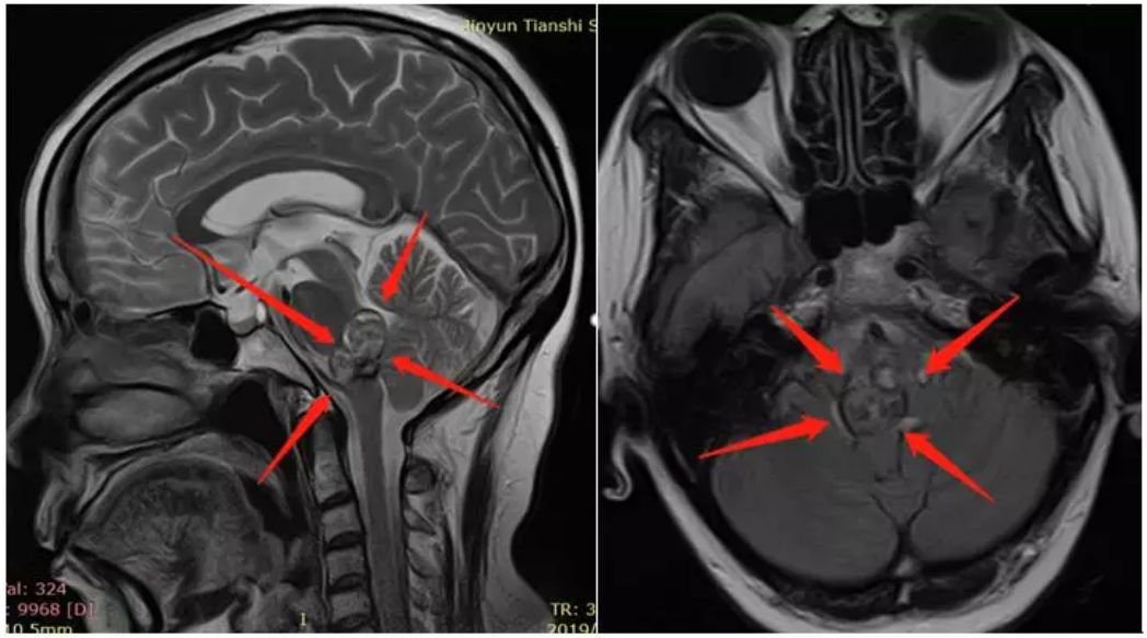 腦干海綿狀血管瘤出血