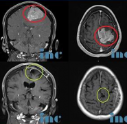 頭暈持續(xù)3月不以為意一查竟是腦膜瘤