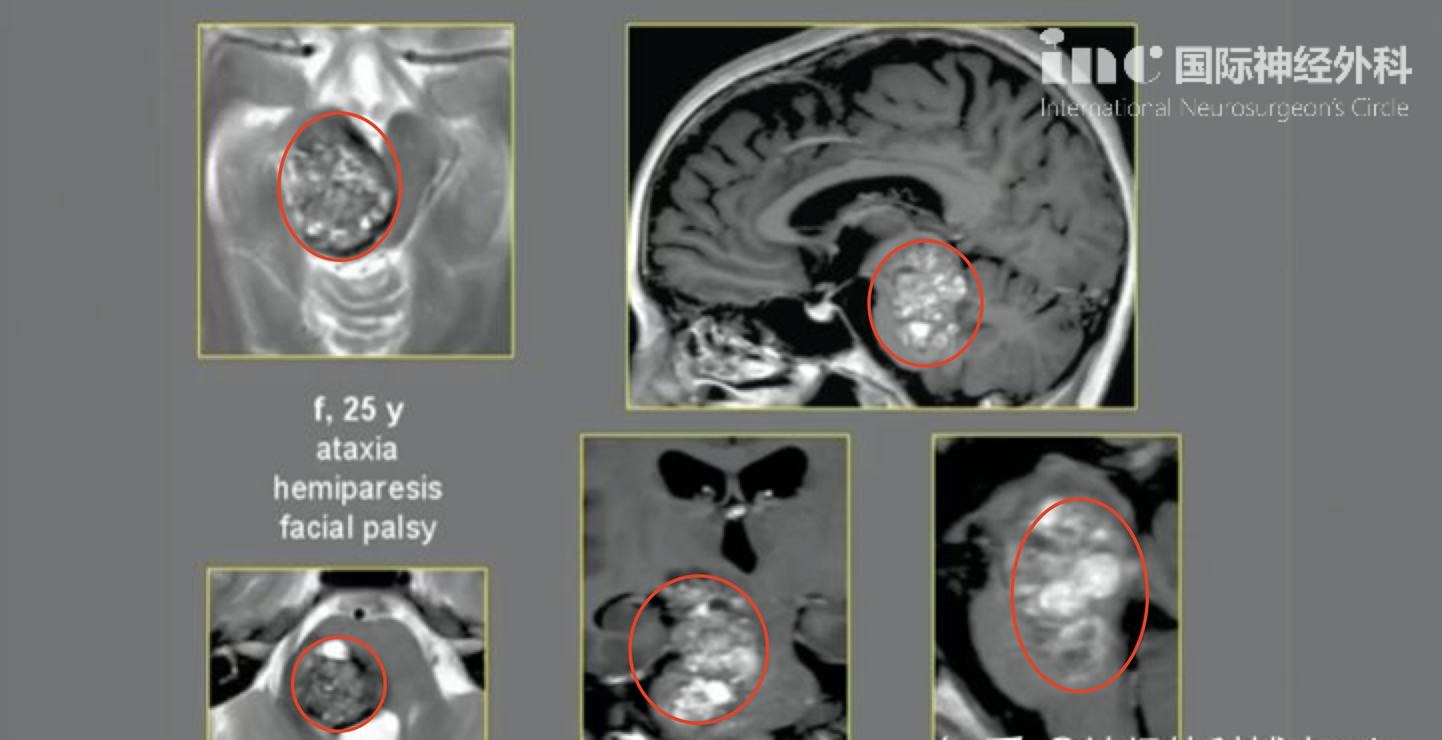 腦干海綿狀血管瘤手術案例