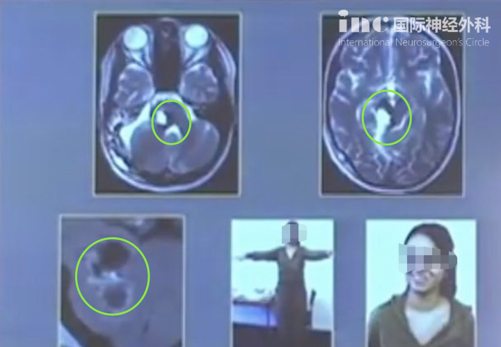 原本癱瘓的25歲女孩，腦干海綿狀血管瘤手術(shù)全切后重新站了起來