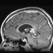 INC德國巴特朗菲教授：關(guān)于小兒顱內(nèi)原發(fā)性間變性神經(jīng)節(jié)膠質(zhì)瘤（AGG）