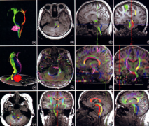 腦干膠質(zhì)瘤影像學(xué)、病理學(xué)、分子學(xué)分型