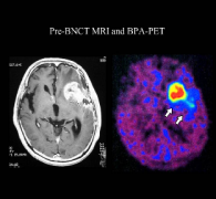 硼中子俘獲療法治療高級別膠質(zhì)瘤現(xiàn)狀