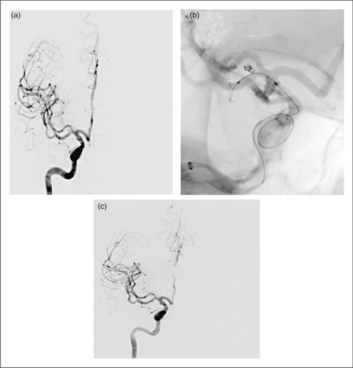 小于3mm的腦動脈瘤介入治療：微彈簧圈栓塞治療預后如何？